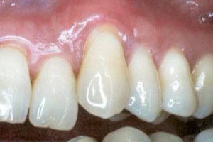 Gingival graft for root coverage after